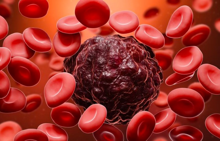 Mengenal Gejala dan Jenis Jenis Kanker Darah